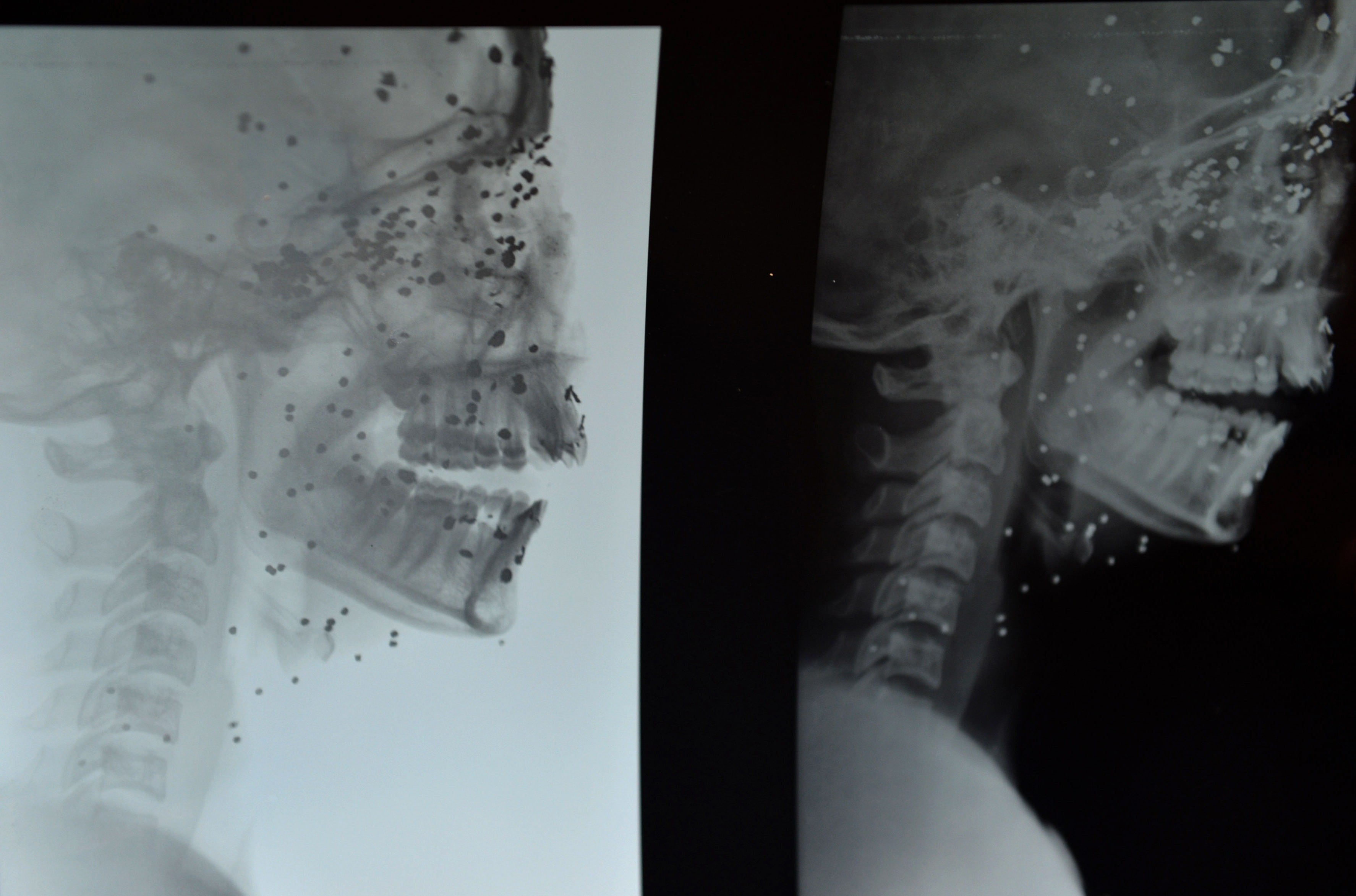 X-ray shows multiple pellet injuries to Insha Malik's face that have left her blind in both eyes. Photo credit: AFP X-ray shows multiple pellet injuries to Insha Malik's face that have left her blind in both eyes. Photo credit: AFP